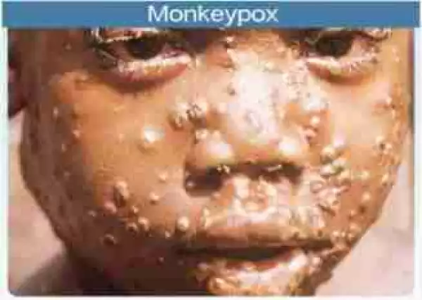 FG Confirms Six Fresh Cases of Monkeypox as Disease Hits Abuja